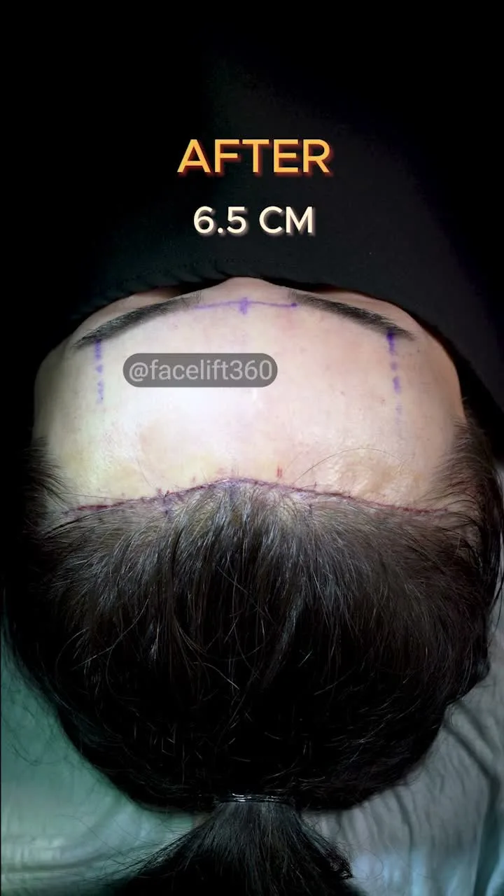بعد از لیفت صورت، مراجع لیفت پیشانی ۲