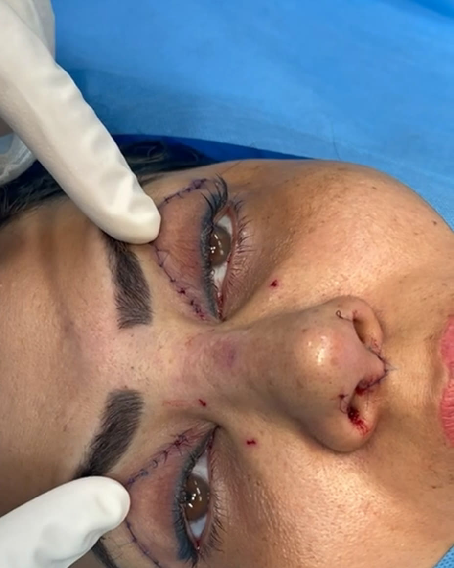 صورة فورية بعد إغلاق شقوق رأب الجفن وتجميل الأنف على طاولة العمليات، نُشرت بموافقة المريضة