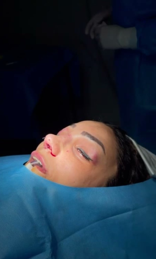 Intra-operative view showing the rhinoplasty incision and temple/eyelid area