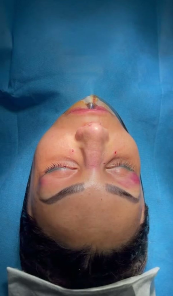 Immediate on-table view with periorbital bruising