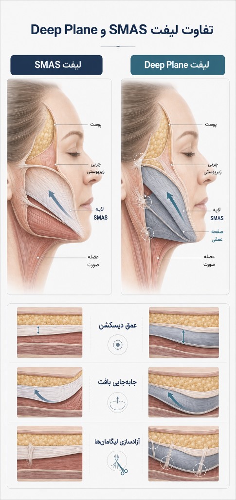 تفاوت لیفت SMAS و Deep Plane — عمق دیسکشن، جابهجایی بافت و آزادسازی لیگامانها