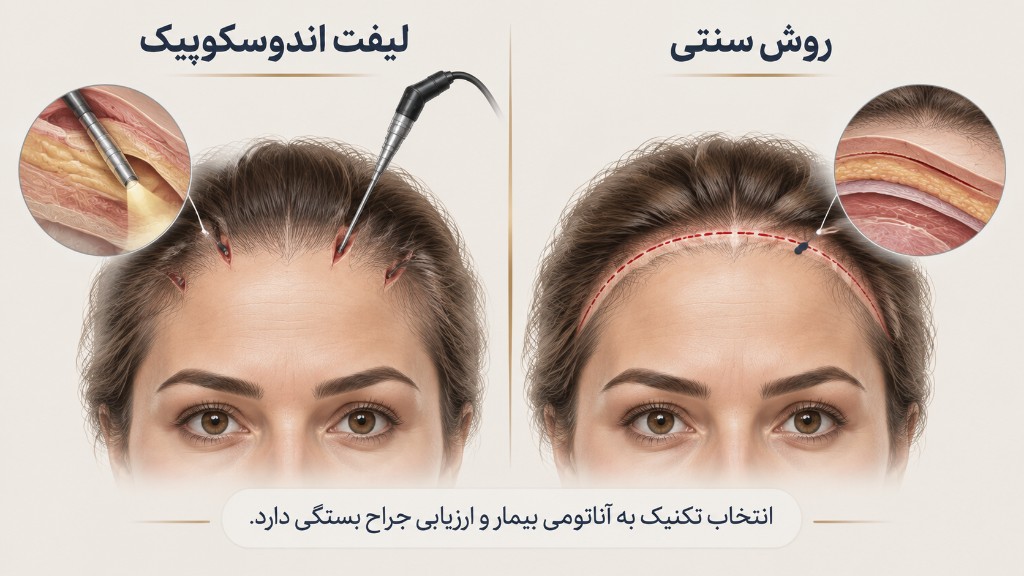 مقایسه لیفت اندوسکوپیک و روش سنتی