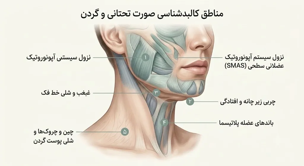 Lower face and neck zones where HIFU is usually not enough