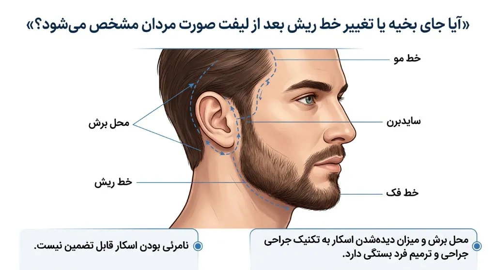 آیا جای بخیه یا تغییر خط ریش بعد از لیفت صورت مردان مشخص می‌شود؟