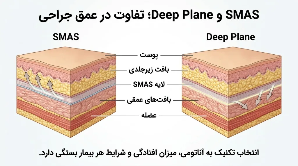 SMAS و Deep Plane؛ تفاوت در عمق جراحی