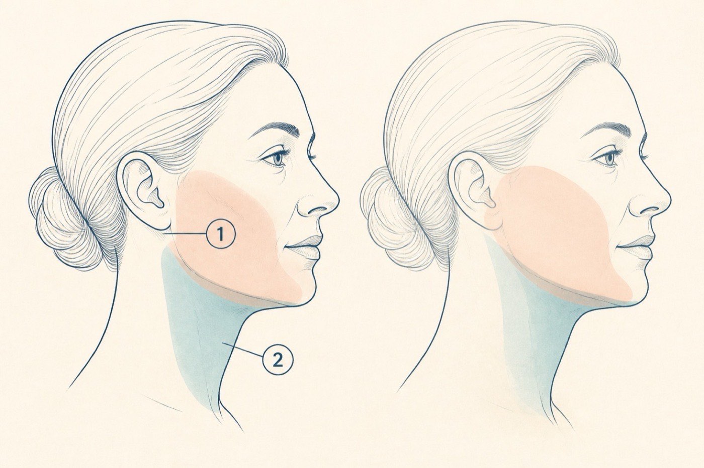 Comparison of neck-lift versus facelift treatment territories